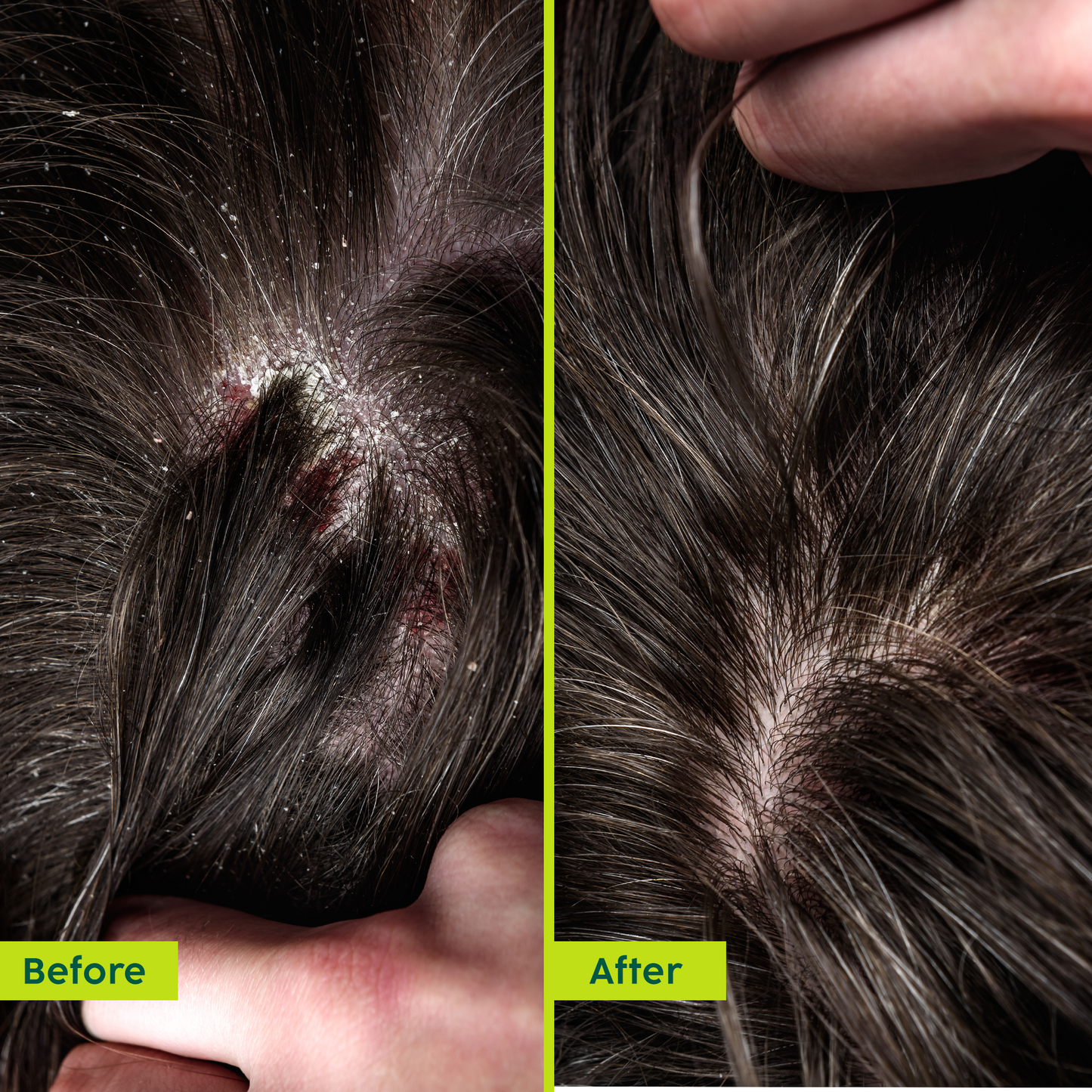 Neem Anti-Dandruff Advanced Hair Oil