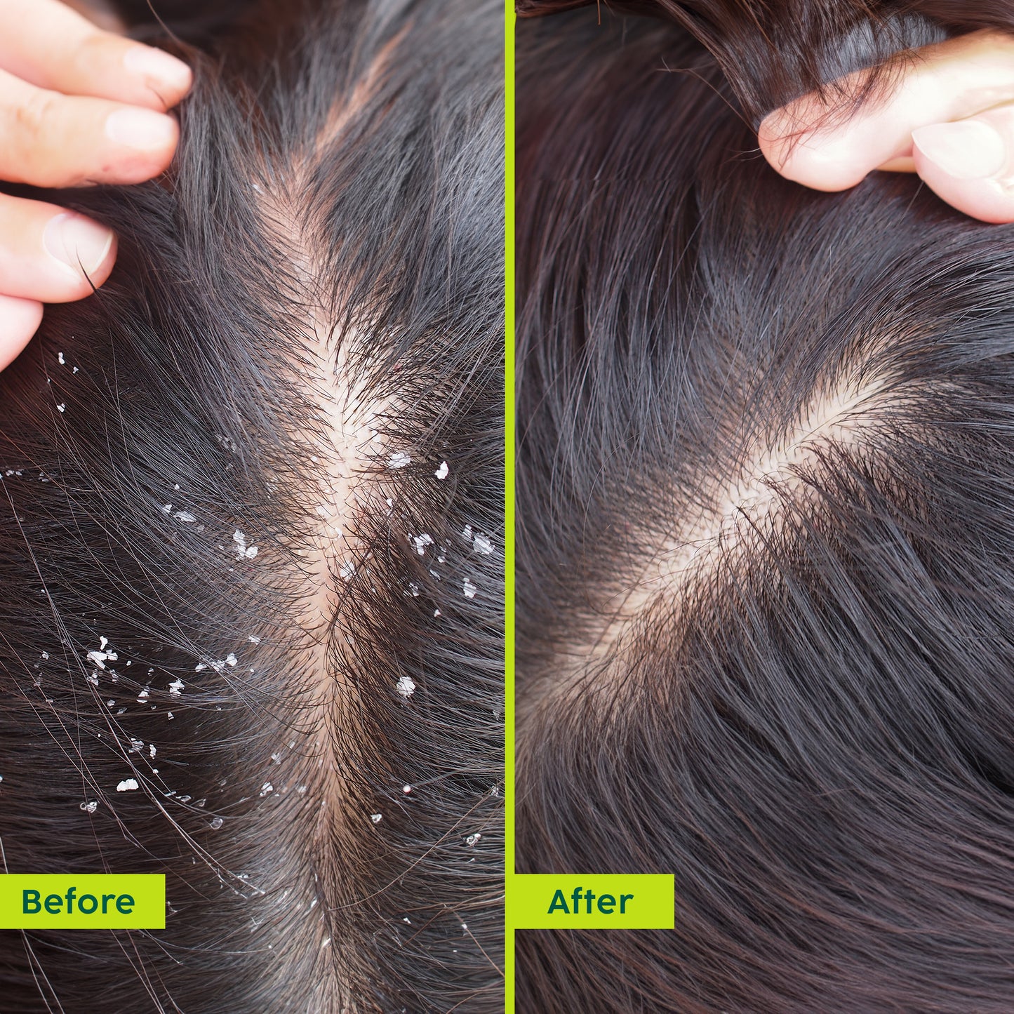 Neem Anti-Dandruff Advanced Hair Oil