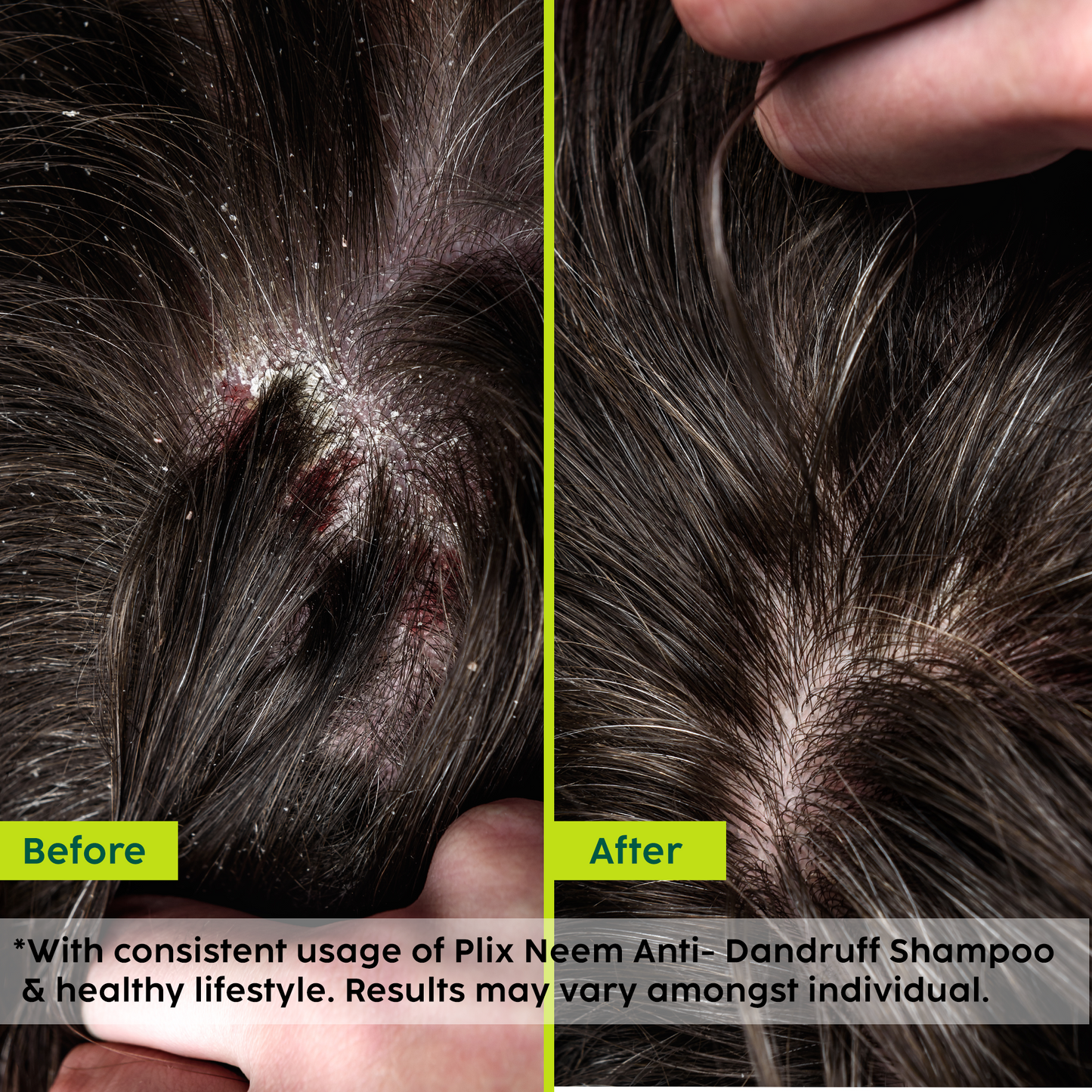 Neem Anti-Dandruff Advanced Hair Serum | Helps Reduce Dandruff, Scalp Itching & Irritation